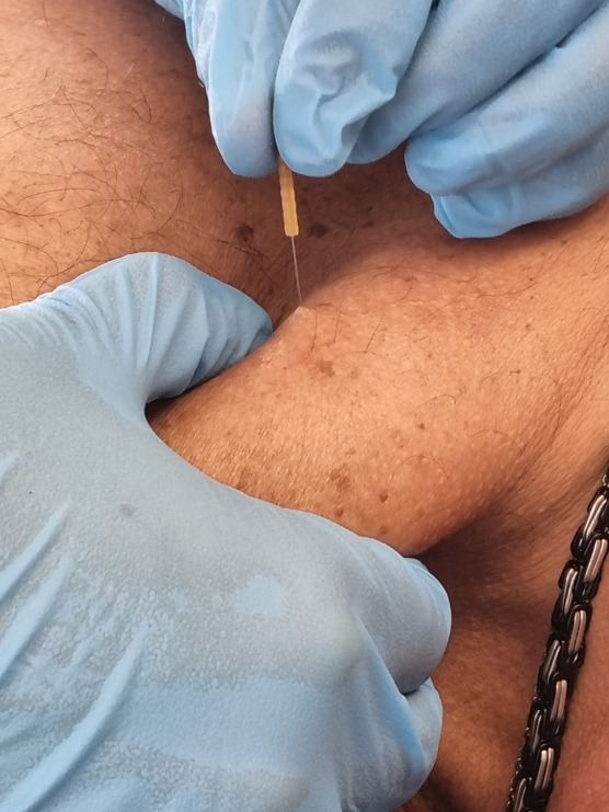 Dry Needling des Trapezius descendens