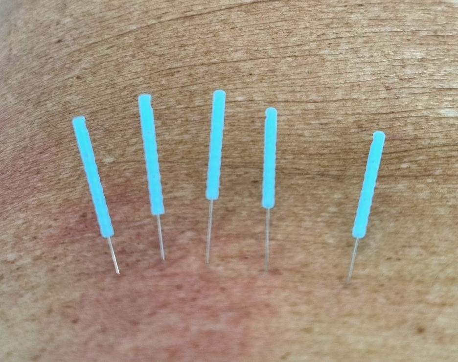 superficiales dry needling mit 5 Nadeln
